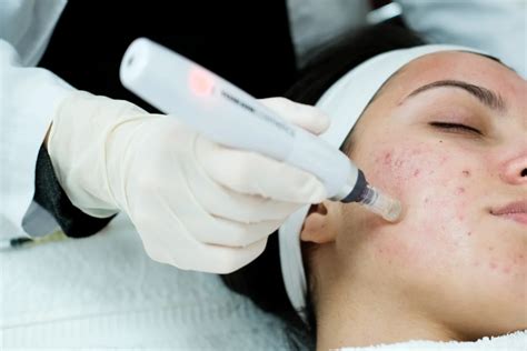 Medizinisches Microneedling Mit Dermapen Aepada