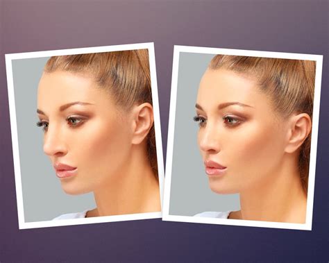 Rhinoplasty Computer Imaging Toronto Solomon Rhinoplasty