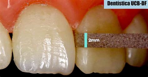 Dent Stica Acabamento E Polimento De Restaura Es Anteriores Em