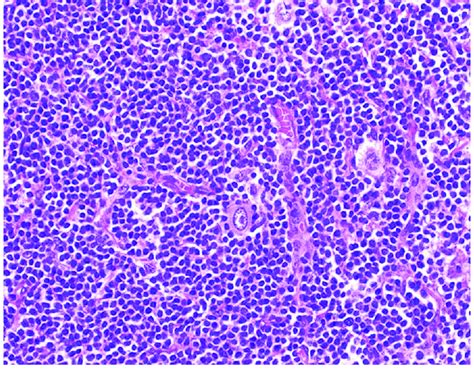 Neck Lymph Node Biopsy