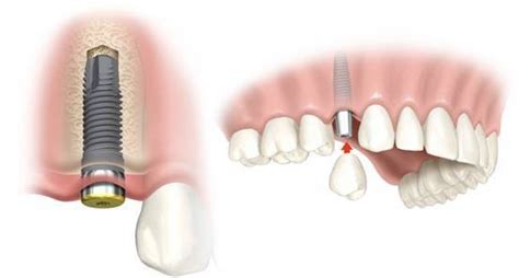 Dental Implants Can Restore Your Smile Dentist Lansdowne Va