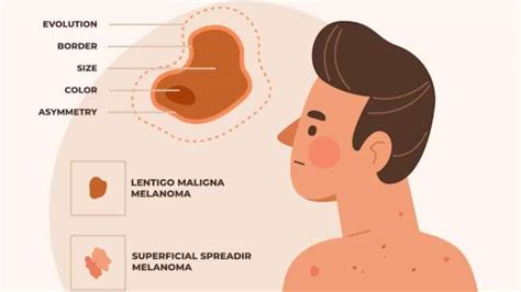 What Is Melanoma Know All About Its Signs Symptoms Causes And