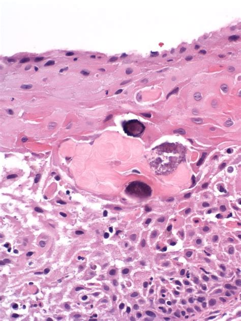 Calcifying Odontogenic Cyst Histopathology