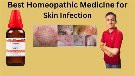 Sulfur 30 Homeopathic Medicine Uses L Skin Problem YouTube