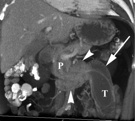 Peripancreatic Masses That Simulate Pancreatic Disease Spectrum Of