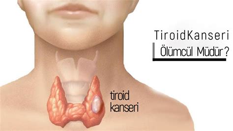 Tiroid kanseri ölümcül müdür Tiroid ve Guatr Cerrahisi Op Dr