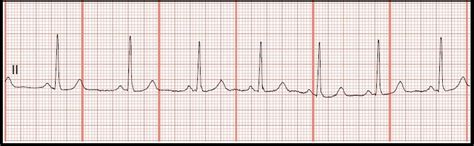 Float Nurse: Practice EKG Rhythm Strips 111