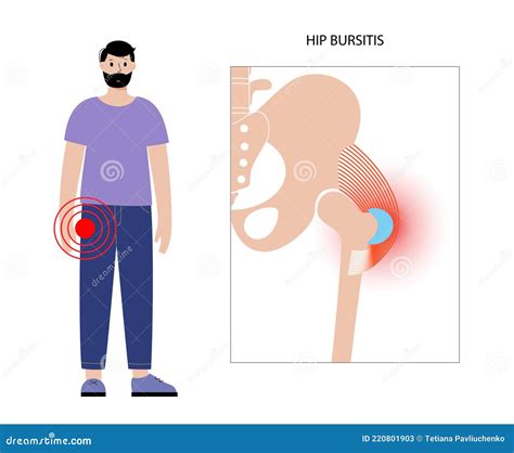 Trochanteric Bursitis As Bursa Inflammation Located In Hip Outline