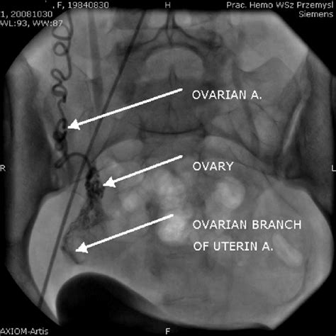 Contrast Medium Flow From The Ovarian Artery Through The Ovary To The