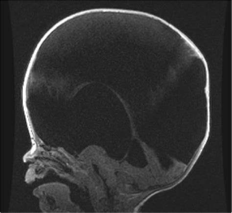 Hydranencephaly Mri