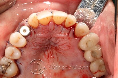 Impacted canine: extraction + implant + graft - DL Oral Surgery