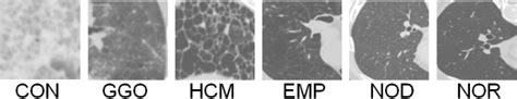 Figure 1 From Classification Of Diffuse Lung Diseases Patterns By A