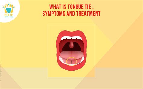 Tongue Tie: Symptoms and Treatment | Elite Dental Care