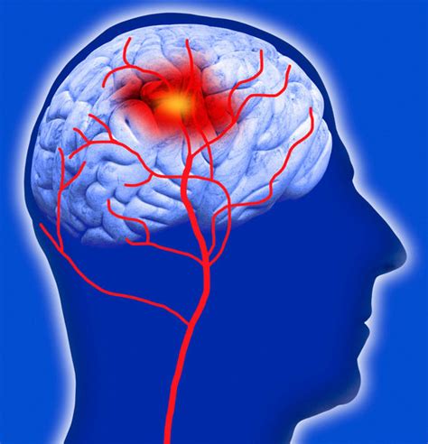 Mini stroke symptoms: Four ways to prevent a TIA | Health | Life & Style | Express.co.uk