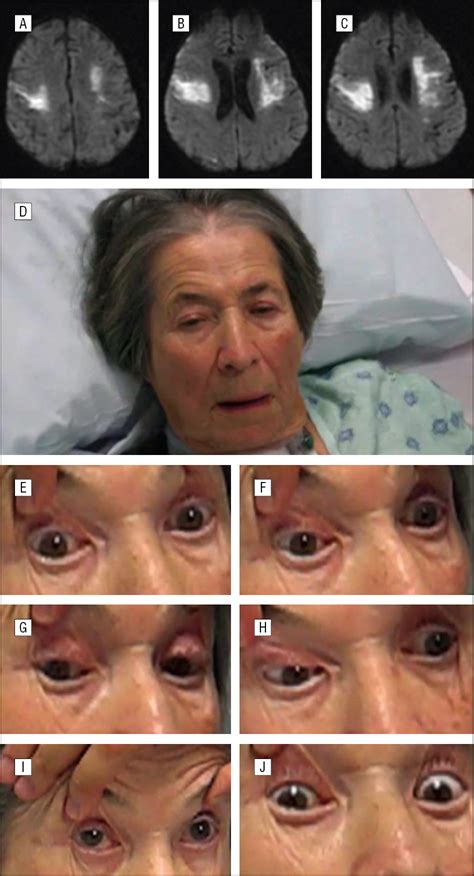 A Variant Of The Anterior Opercular Syndrome With Supranuclear Gaze Palsy Ophthalmology Jama