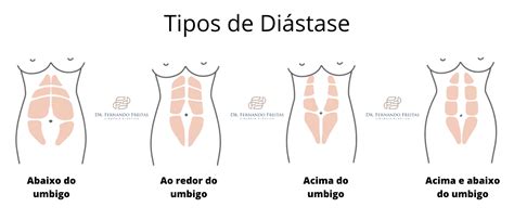 Di Stase Abdominal O Que E Como Tratar Dr Fernando Freitas