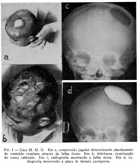 SciELO Brasil Cranioplastia tântalo Cranioplastia tântalo