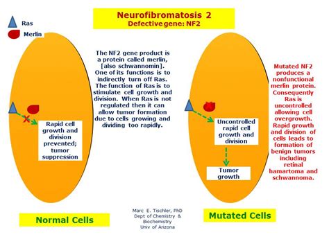 Neurofibromatosis Type II | Hereditary Ocular Diseases