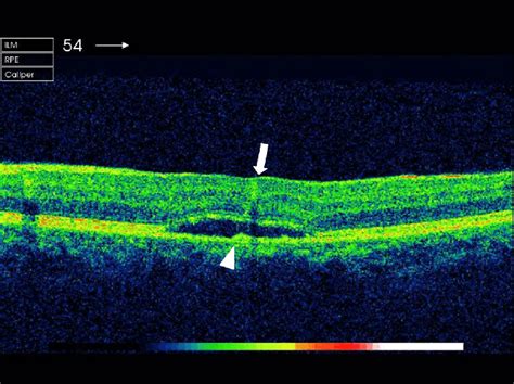 Serous Retinal Detachment Under The Neurosensory Retina In Optical