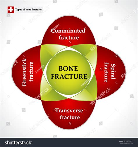 Types Bone Fractures Colorful Chart Stock Vector Royalty Free