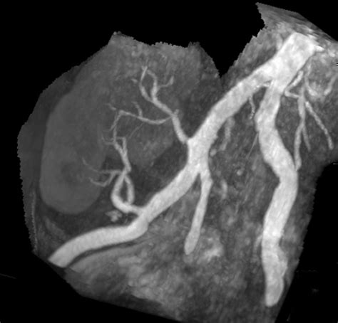 Phase Contrast Mra Questions And Answers In Mri