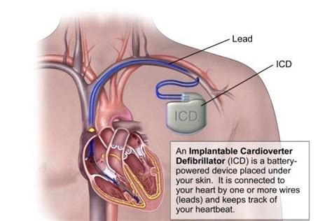 Cardiac Resynchronization Therapy Crt Patient9 Medium