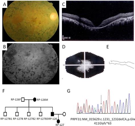 The Phenotypes And Mutation Of Patient RP 126 Who Carries A