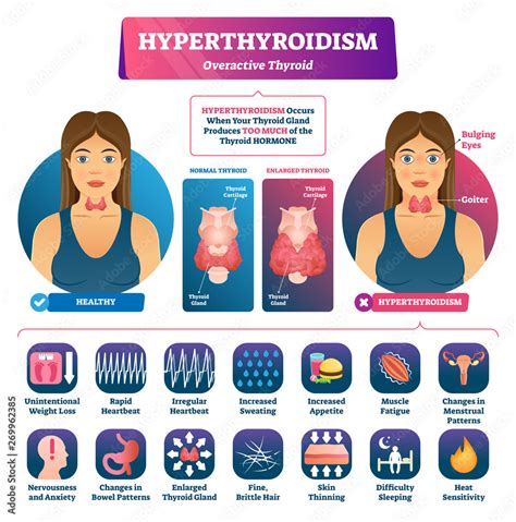 Hyperthyroidism Vector Illustration Labeled Medical Thyroid Gland The