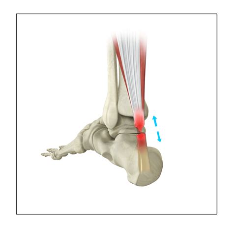 Achilles Tendon Rupture Pasadena | Achilles Tendon Repair or Injury La ...