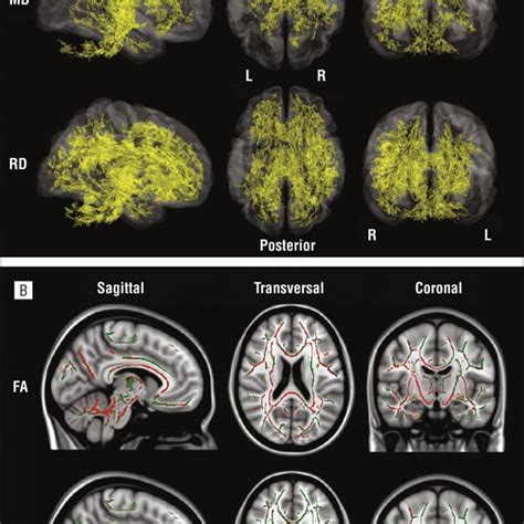 Harm Avoidance And White Matter Microstructure The Spatial