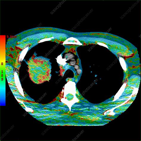 Lung cancer, CT scan - Stock Image - C035/3608 - Science Photo Library