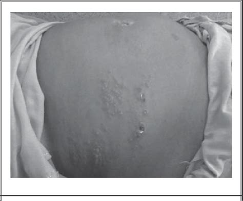 Characteristic Vesiculobullous Eruptions In A Dermatomal Distribution