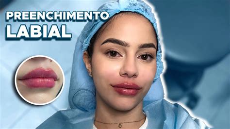 Preenchimento Labial Como é Feito Dor Inchaço Recuperação Antes E