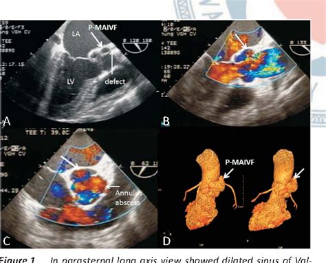 Figure 1 From A Rare And Life Threatening Complication Of Infective