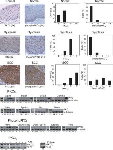 Pkc Expression In Normal Dysplastic And Malignant Scchn Tissues And Download Scientific