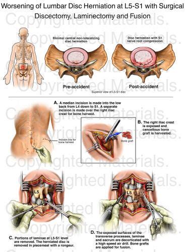 Worsening Of Lumbar Disc Herniation At L5 S1 With Surgical Discectomy