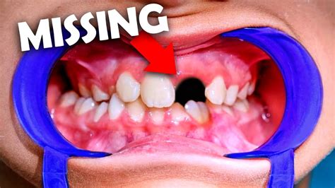 Heres How Orthodontist Deals With Missing Teeth Youtube