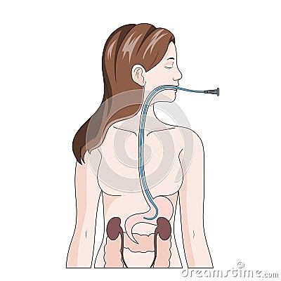 Nasogastric Intubation Medical Science Stock Illustration