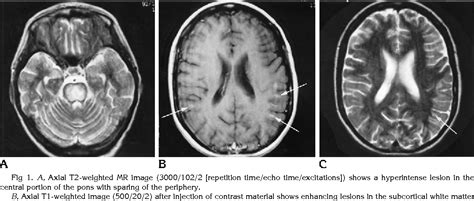 Figure 1 from Subcortical white matter lesions in osmotic demyelination ...