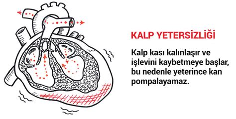 Kalp Yetmezli I Nedir Kalp Yetmezli Inin Tedavisi Aykut Sarita