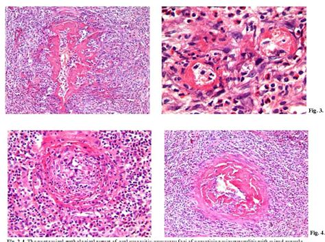 Figure 3 From Oral Necrotizing Microvasculitis In A Patient Affected By