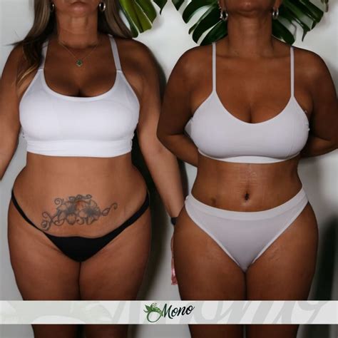 Tummy Tuck Turkey Cost Best Abdominoplasty Surgeons Reviews