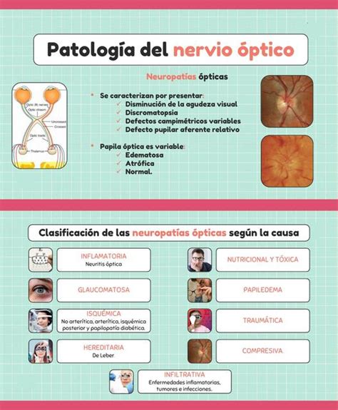 Neuritis óptica Javier Rios uDocz