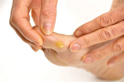 Callus On Foot Removal