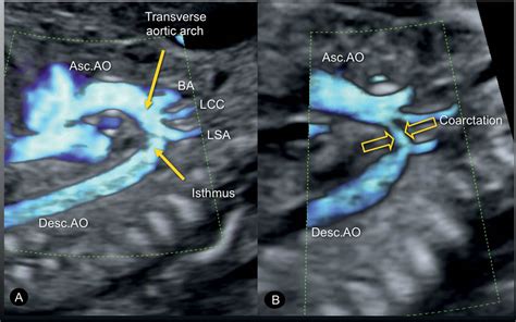 Interrupted aortic arch neural crest - palmkool