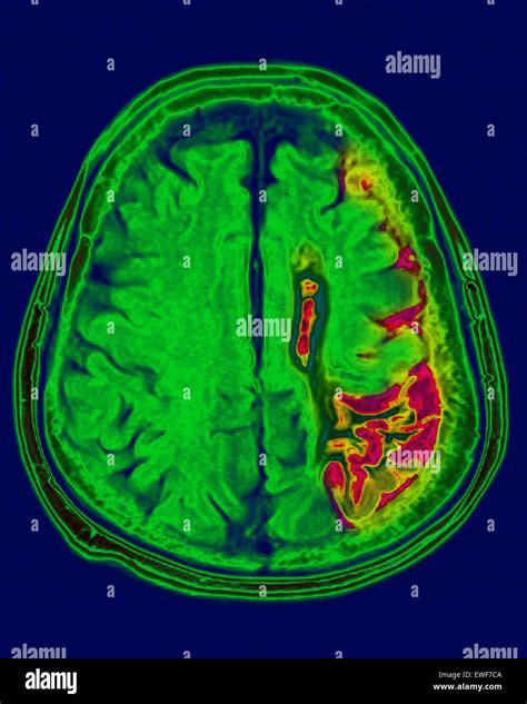 CEREBRAL ATROPHY, MRI Stock Photo - Alamy