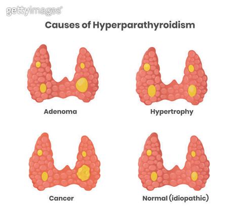 Hyperparathyroidism Causes Illustration Adenoma Cancer Enlargement