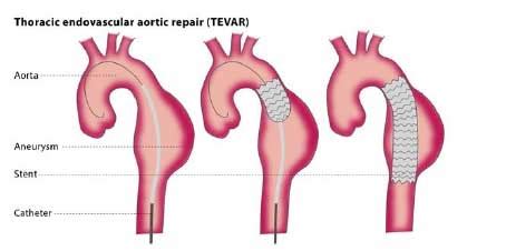 G S Aort Anevr Zmalari Ve Tedav S Prof Dr Cengiz K Ksal