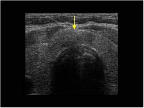 Thyroid Isthmus Ultrasound