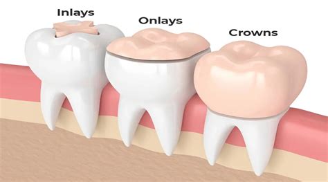 Onlays Clinica Dental Sonrisa Segura